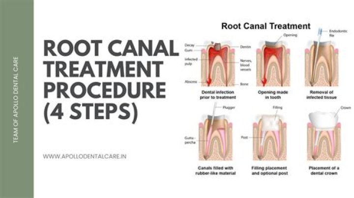 How do you put a MTA on a root canal?