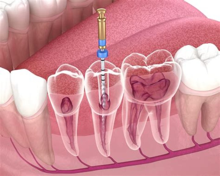 What is MTA in endodontics?
